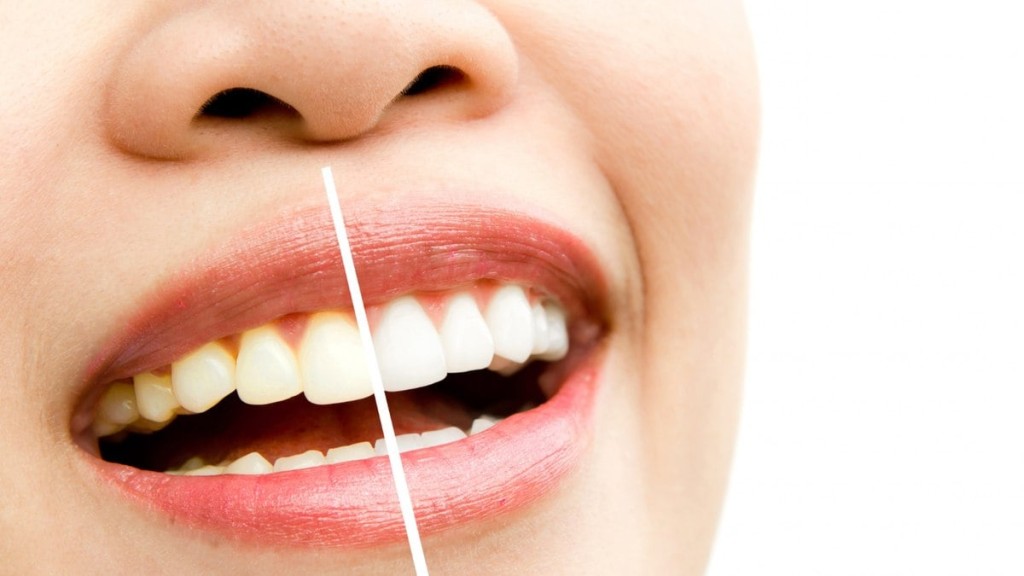 Clareamento dental: procedimento causa sensibilidade; entenda o motivo