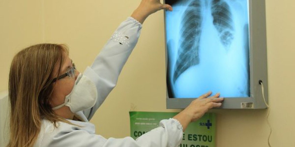 Brasil instala comitê interministerial para eliminação da tuberculose 